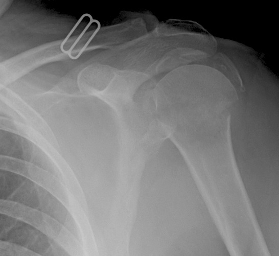 Proximal Humerus 4 Part Fracture